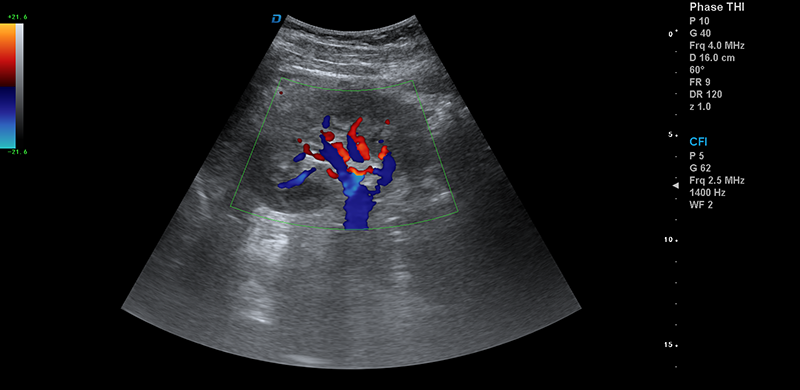 彩超機腎臟血流檢測圖