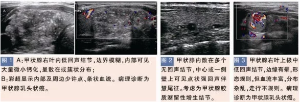 甲狀腺良性結(jié)節(jié)的特征性表現(xiàn)彩超檢測圖