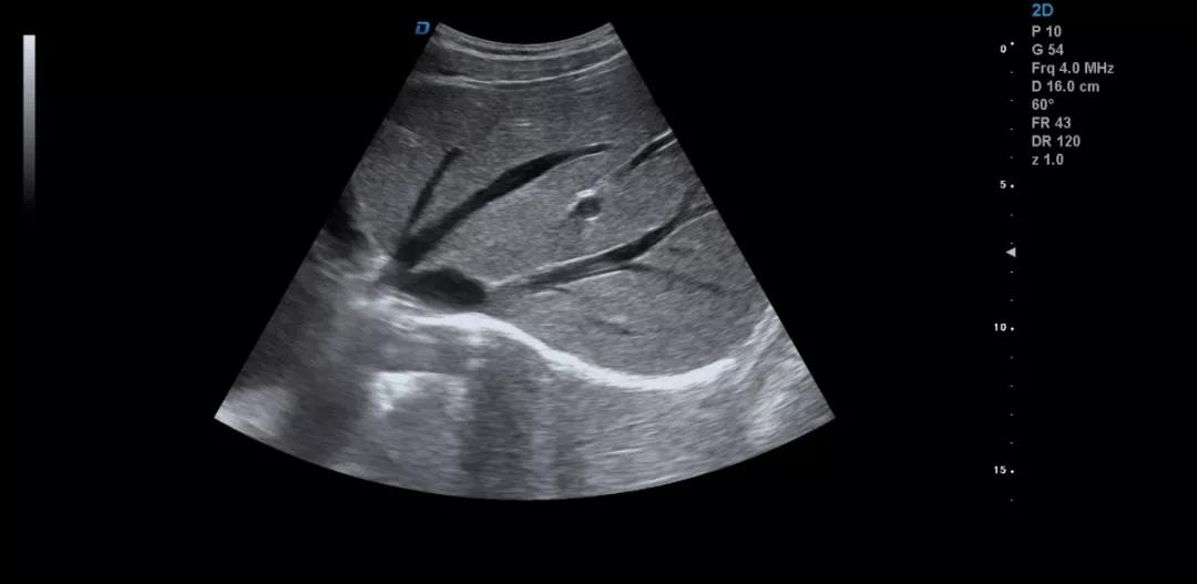 彩超機檢查肝臟超聲方法